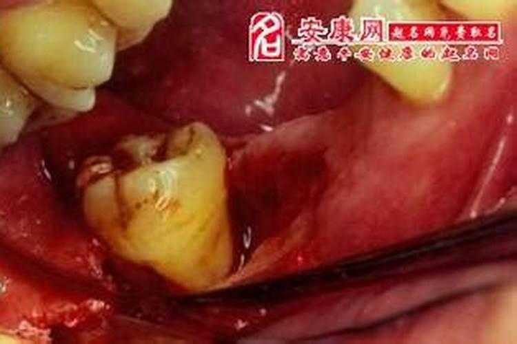 梦见掉了一把牙齿没有流血