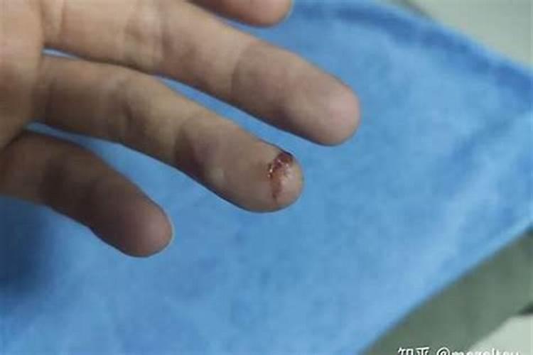 梦见手被划伤又愈合