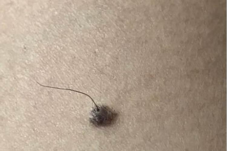 痣毛剪掉会影响运气吗？