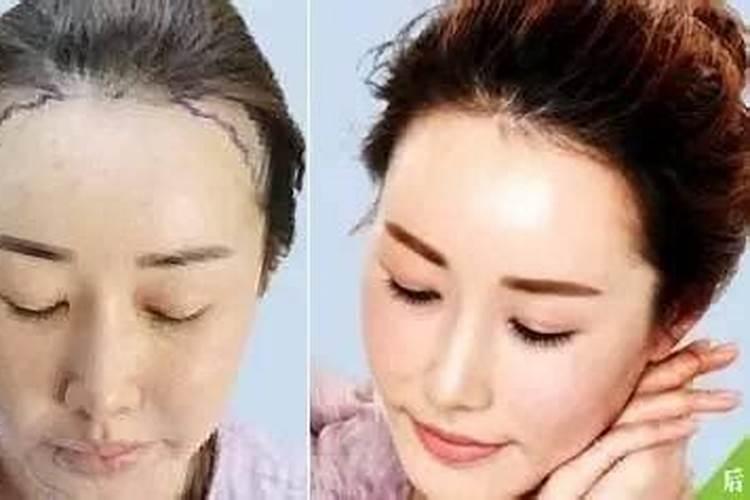 改变发际线可以改变运势吗？