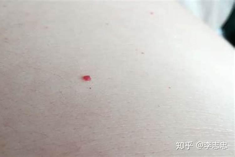 婚姻不顺身上突然长红痣
