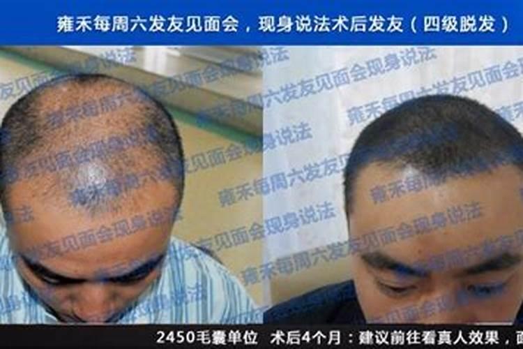 植发后会影响运势吗？