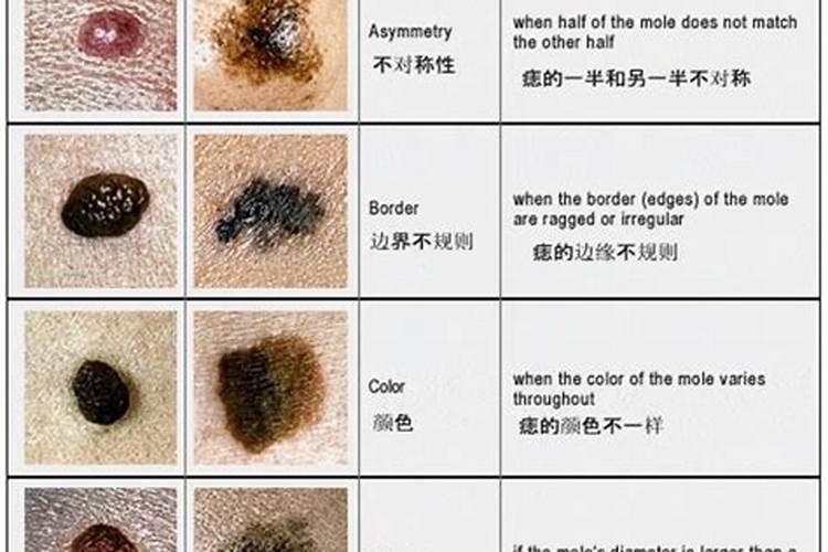 痣消失了预示什么意思？