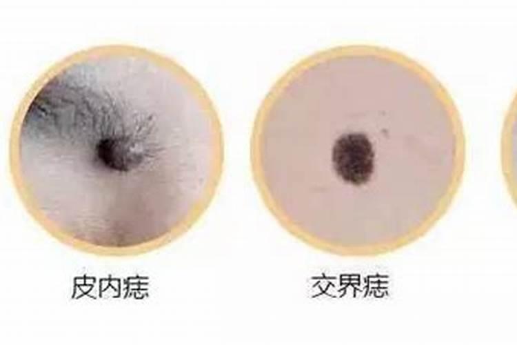 童子身上都是什么痣？