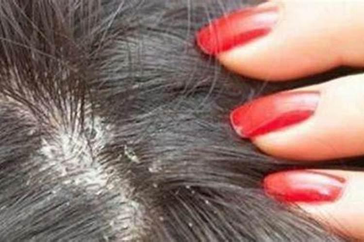 梦见死去亲人头上长虱子