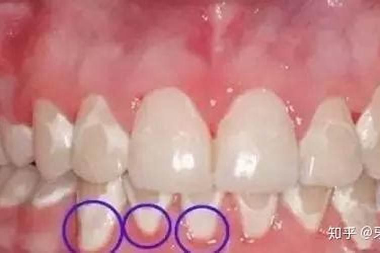 除夕掉牙预示着什么？