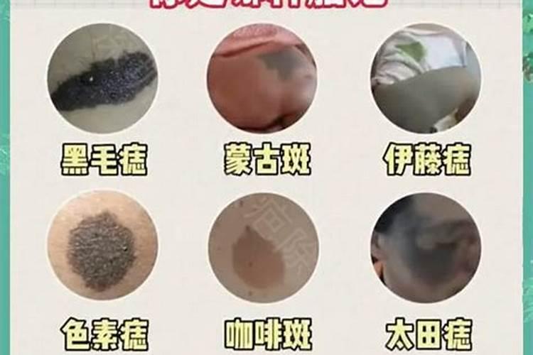 童子命大腿内侧有胎记